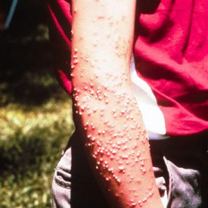 white person's arm covered in tiny red bumps