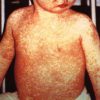 Child with rash on arms chest and face